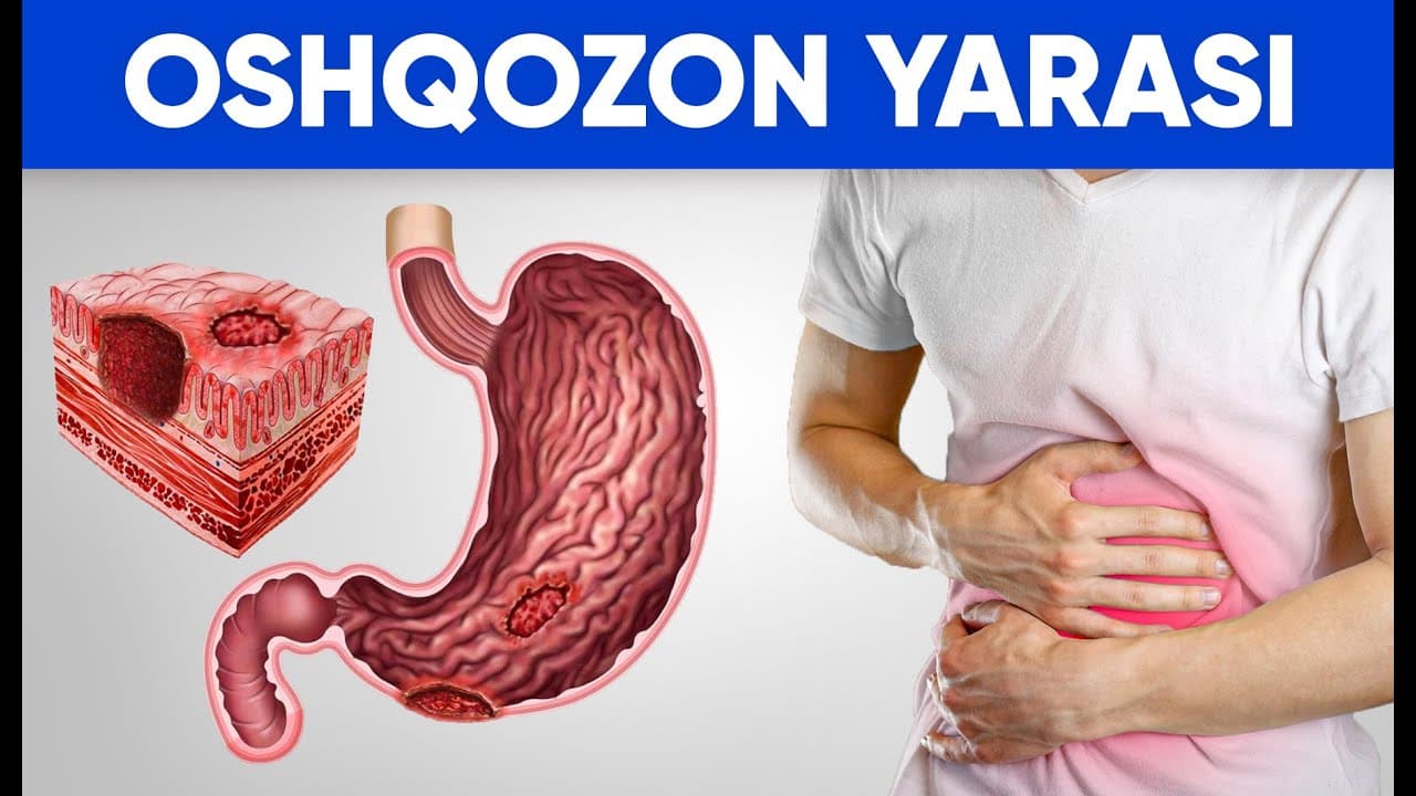 Oshqozon yarasi sabablari | Davolash usullari